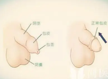 小孩包茎粘连图片