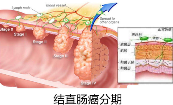 直肠癌早期的5大症状