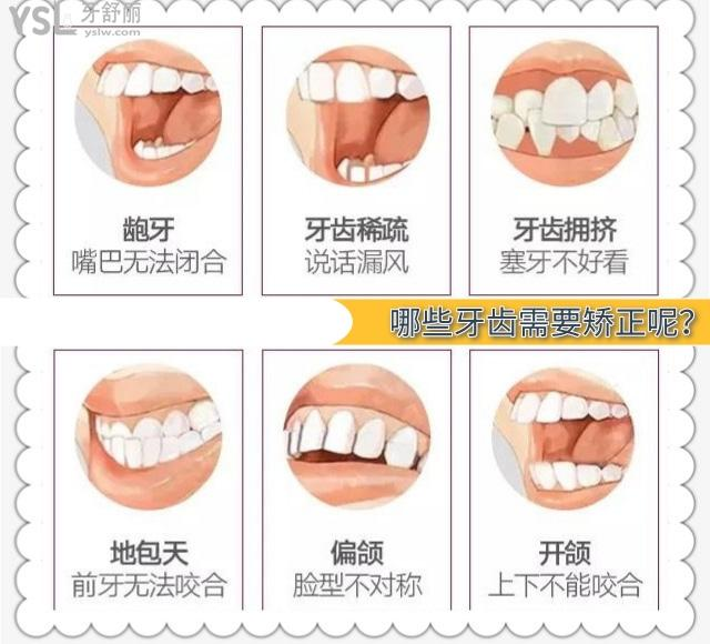 过了25岁最好不要矫正牙齿