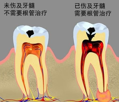 牙周治疗四个步骤