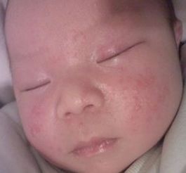 出生婴儿过敏湿疹怎么办