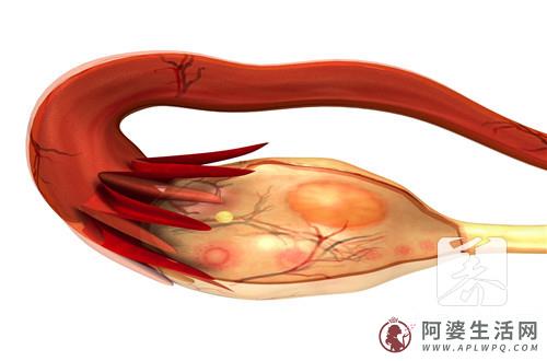 什么样的人非常容易得卵巢癌