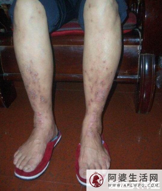 5种类型的湿疹症状图片，不致命但瘙痒难耐还会造成严重皮损