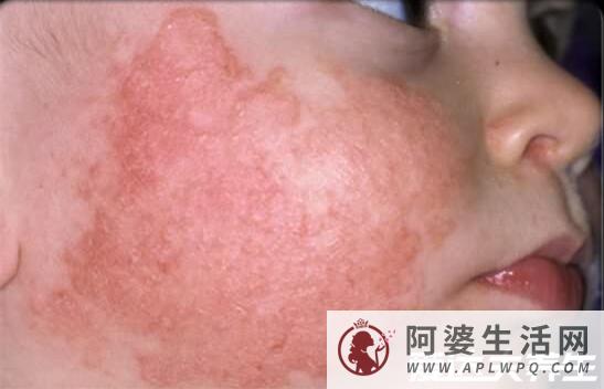5种类型的湿疹症状图片，不致命但瘙痒难耐还会造成严重皮损