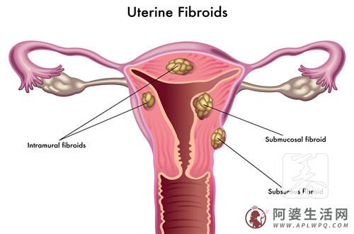 子宫肌瘤2厘米严重吗，2公分该怎么办