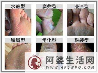 5种普通皮癣图片早期症状，手藓足藓成人多见(甲藓就是灰指甲)