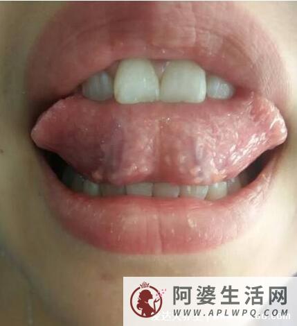 口腔舌系带疣体图片看看自己是不是会得口腔尖锐湿疣