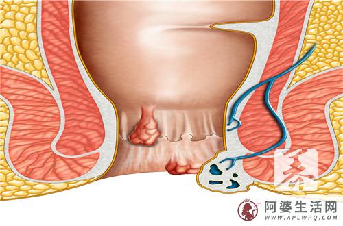 顺产后的痔疮如何恢复