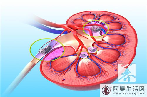 女性尿结石非常容易排出来吗？结石怎么排？